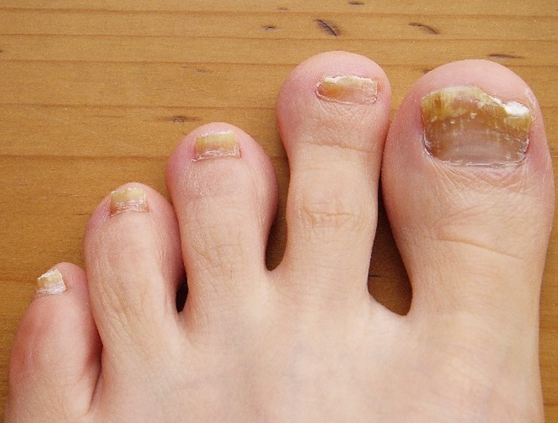 Types of toenail fungus - Awesome Nail
