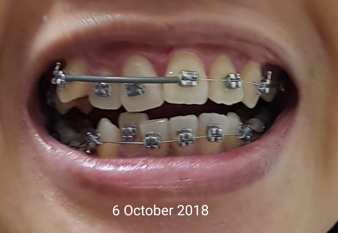 nanyfadhly Braces Story Updated! Part 4