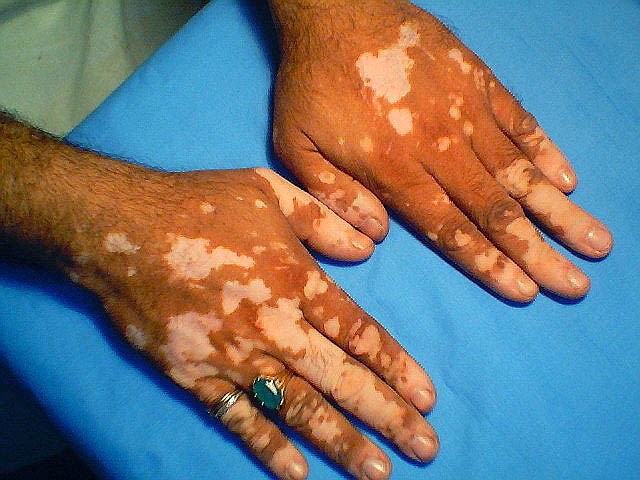 descubren-cura-vitiligo