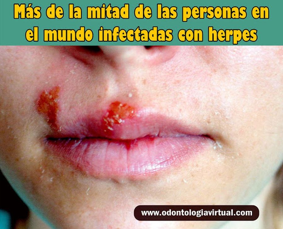 HERPES LABIAL Más de la mitad de las personas en el mundo infectadas