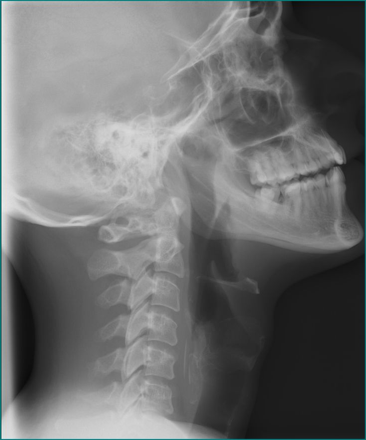 24 y/o female presents with throat pain which developed while eating