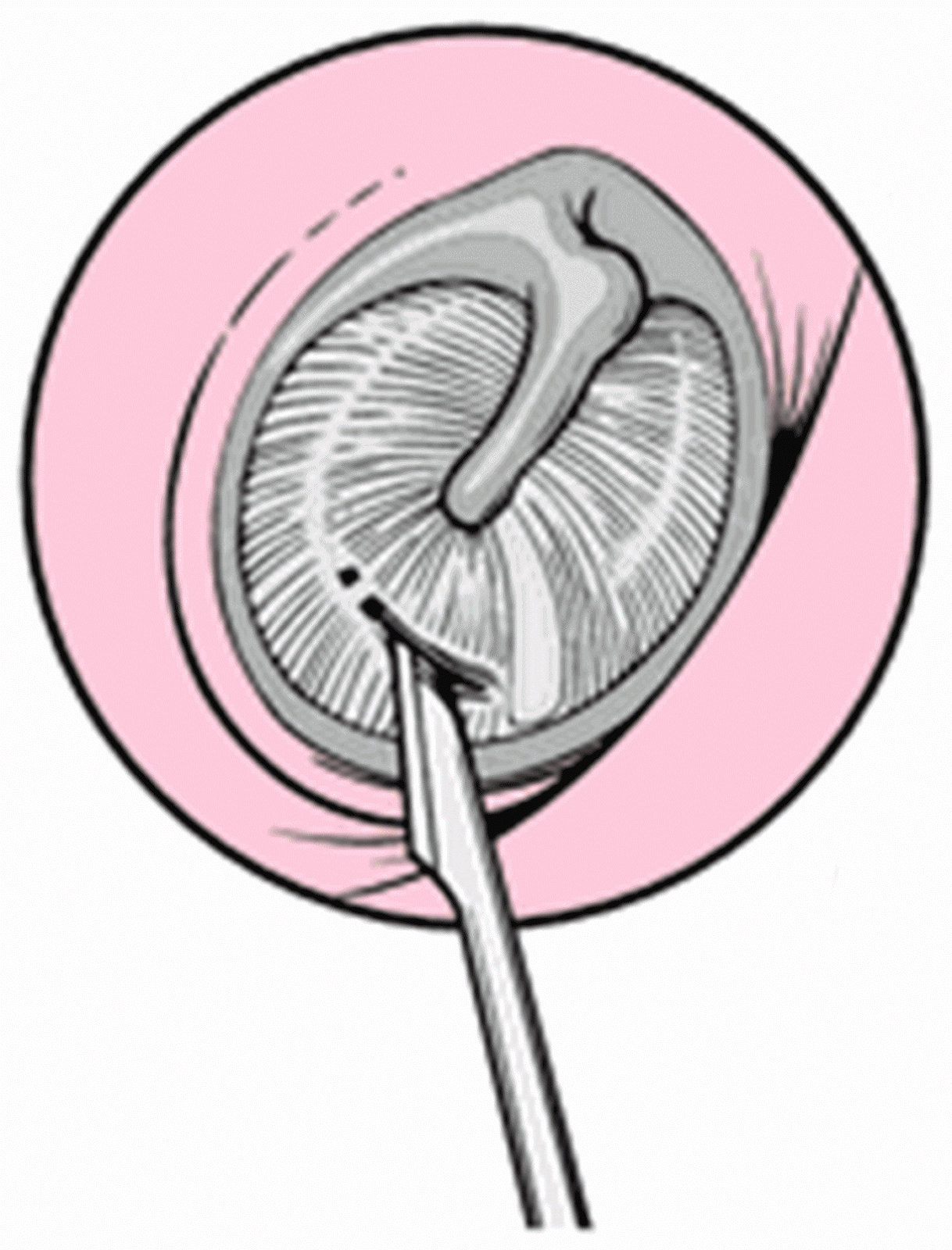 Ear Ventilation Tubes