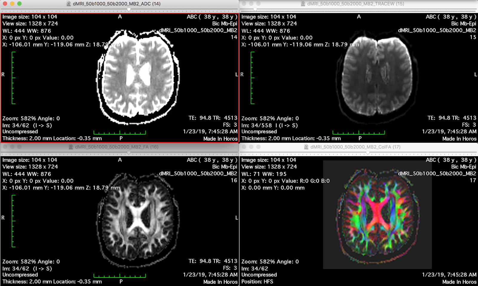 practiCal fMRI: the nuts & bolts: Using multiband-EPI for diffusion ...