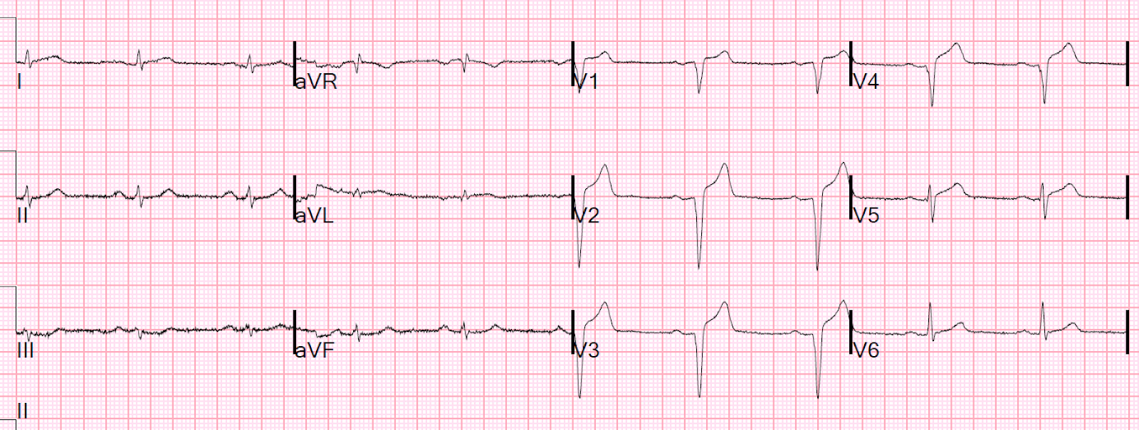 Dr. Smith's ECG Blog Anterior STEMI and multiform PVCs with Narrow