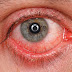 Lacrimal Caruncle - Swollen, Itchy, Infection, Cyst