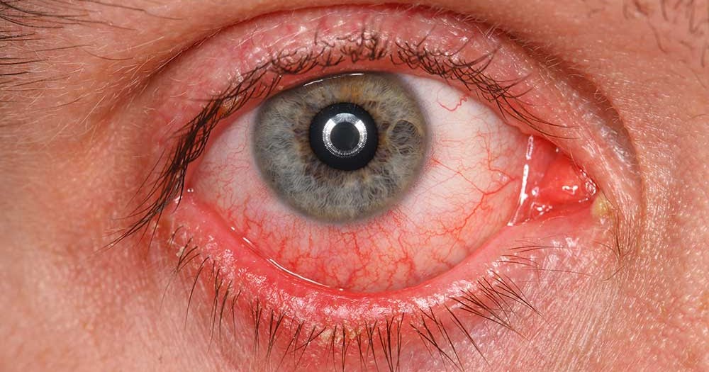 Lacrimal Caruncle Swollen, Itchy, Infection, Cyst Health Care Tips