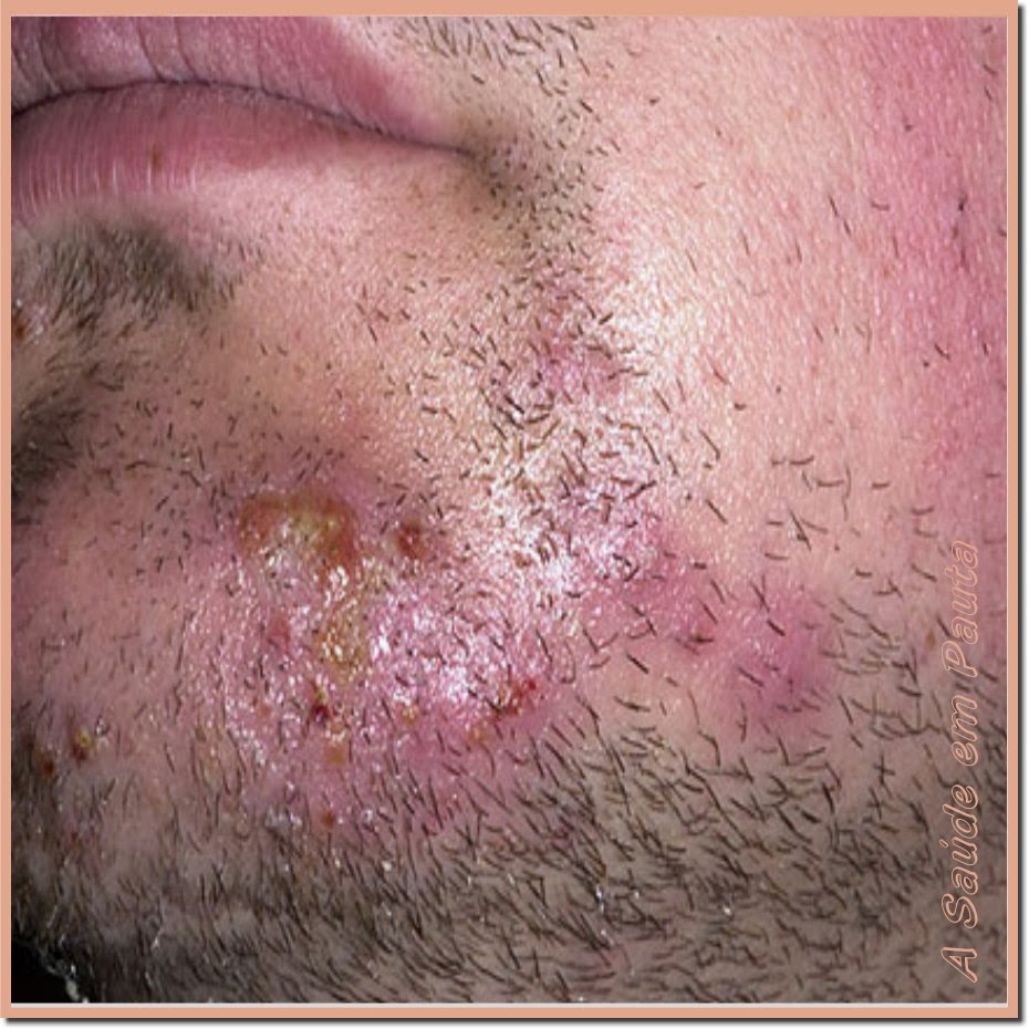 Pseudofolliculitis barbae: symptomen, oorzaak en ...