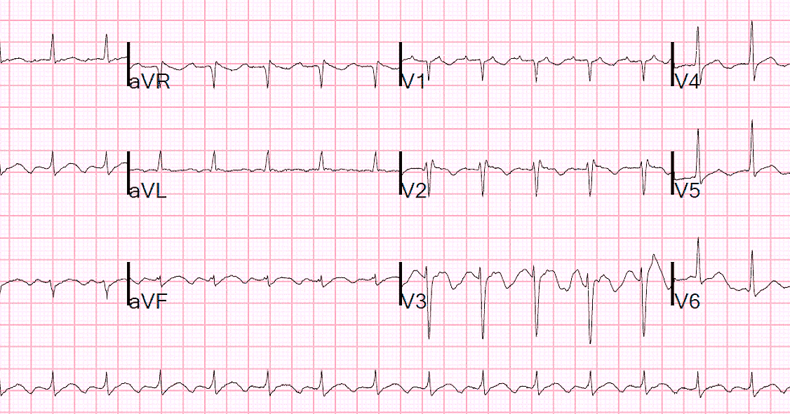 перегрузка сердца на экг. признаки перегрузки правых отделов сердца на экг. экг при гипертрофиях предсердий и желудочков сердца. систолическая перегрузка правого желудочка на экг. гипертрофия правых отделов сердца на экг.