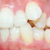 Ưu điểm của phương pháp bọc răng sứ là gì?