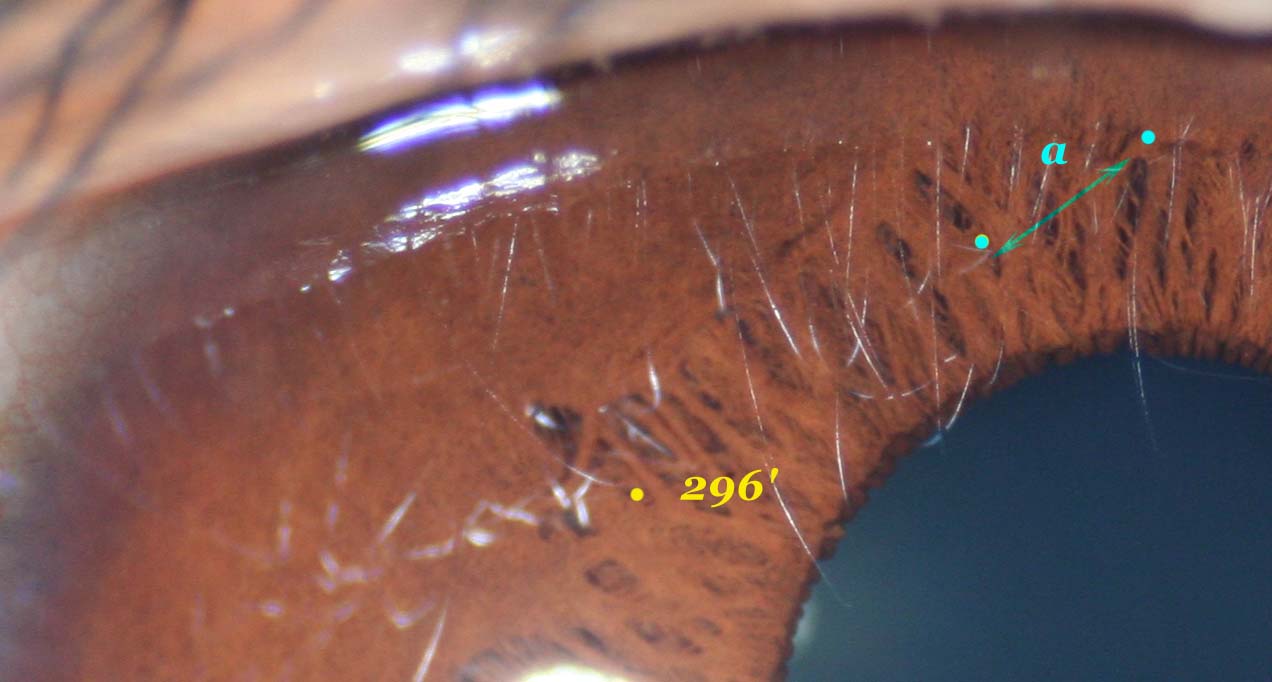 Modern & Multidimensional Iridology Crypts, Internal Lacunae