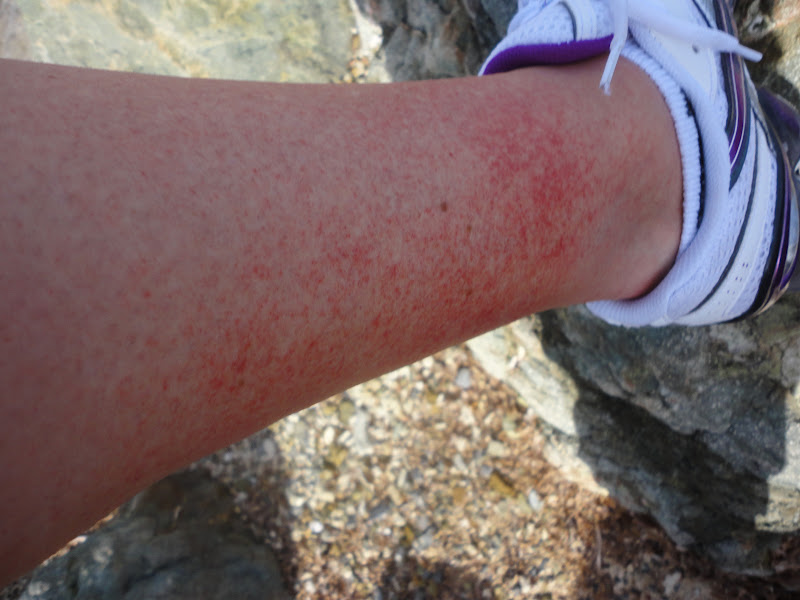 SUE'S ESCAPE FROM CANCERLAND Golfer's vasculitis redux