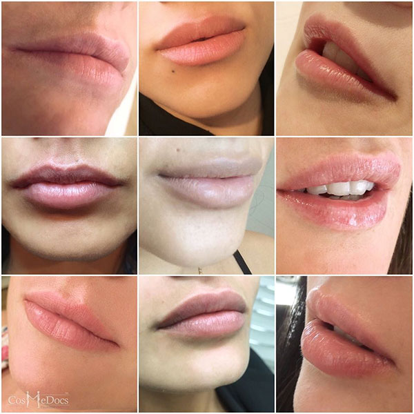 Featured image of post Lip Filler Kinds Permanent and semipermanent fillers while tempting are not