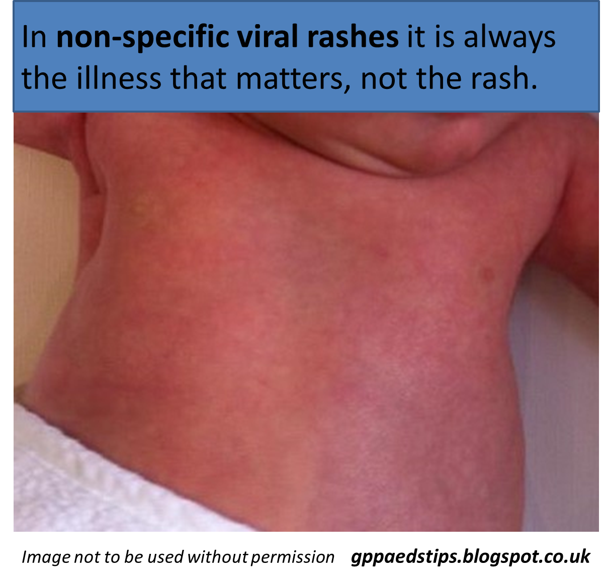 Paediatrics for Primary Care (and anyone else) Rashes in children