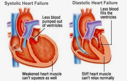 Systolic And Diastolic Heart Failure