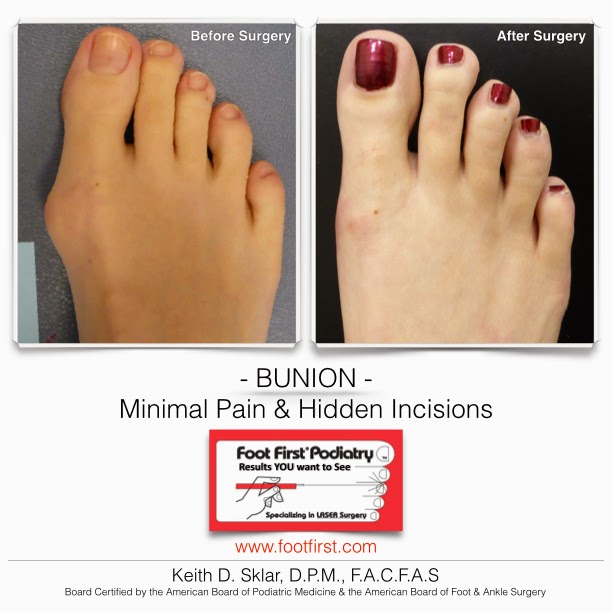 Bunion Surgery The Before and After Results. Bunion Photos Before