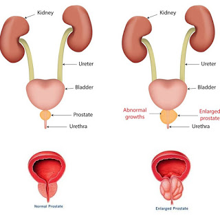 Prostatitis kékben)