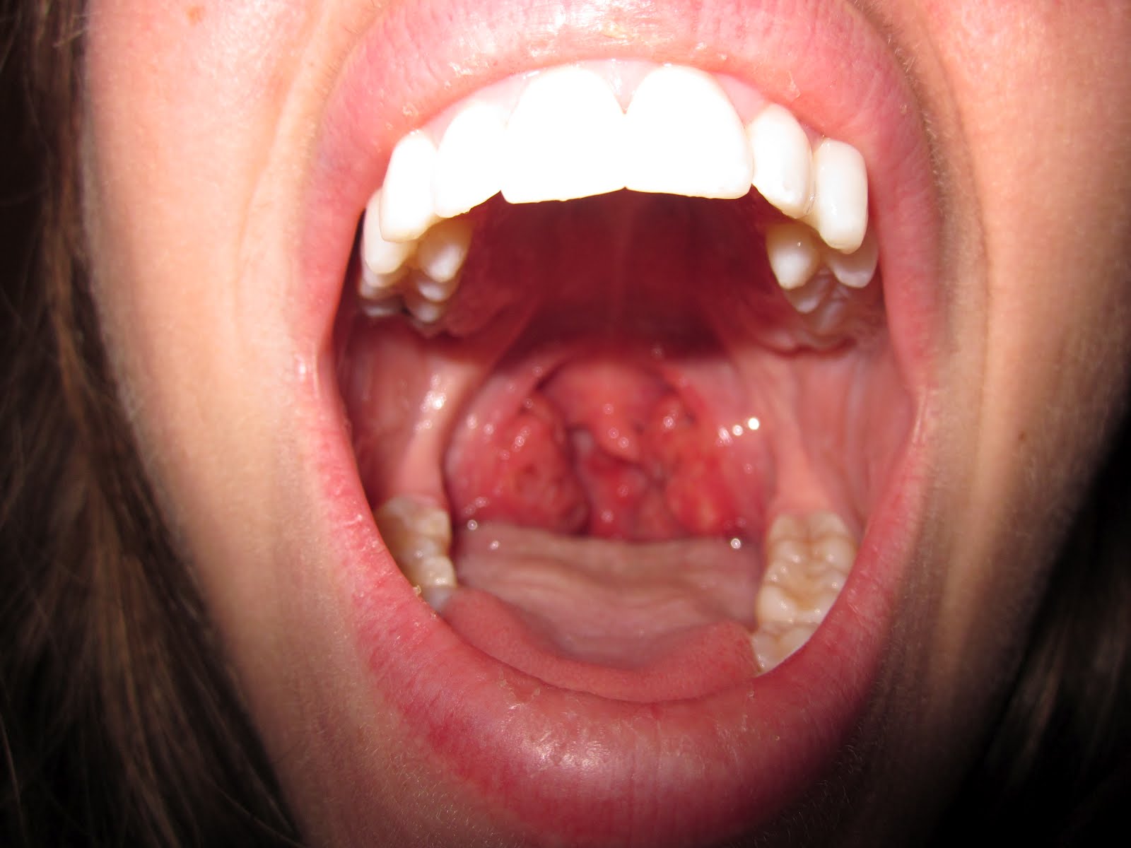 Pictures Of A Normal Throat 117