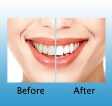 Laser Dentist India Laser Teeth Whitening In India