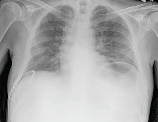 Reexpansion Pulmonary Edema