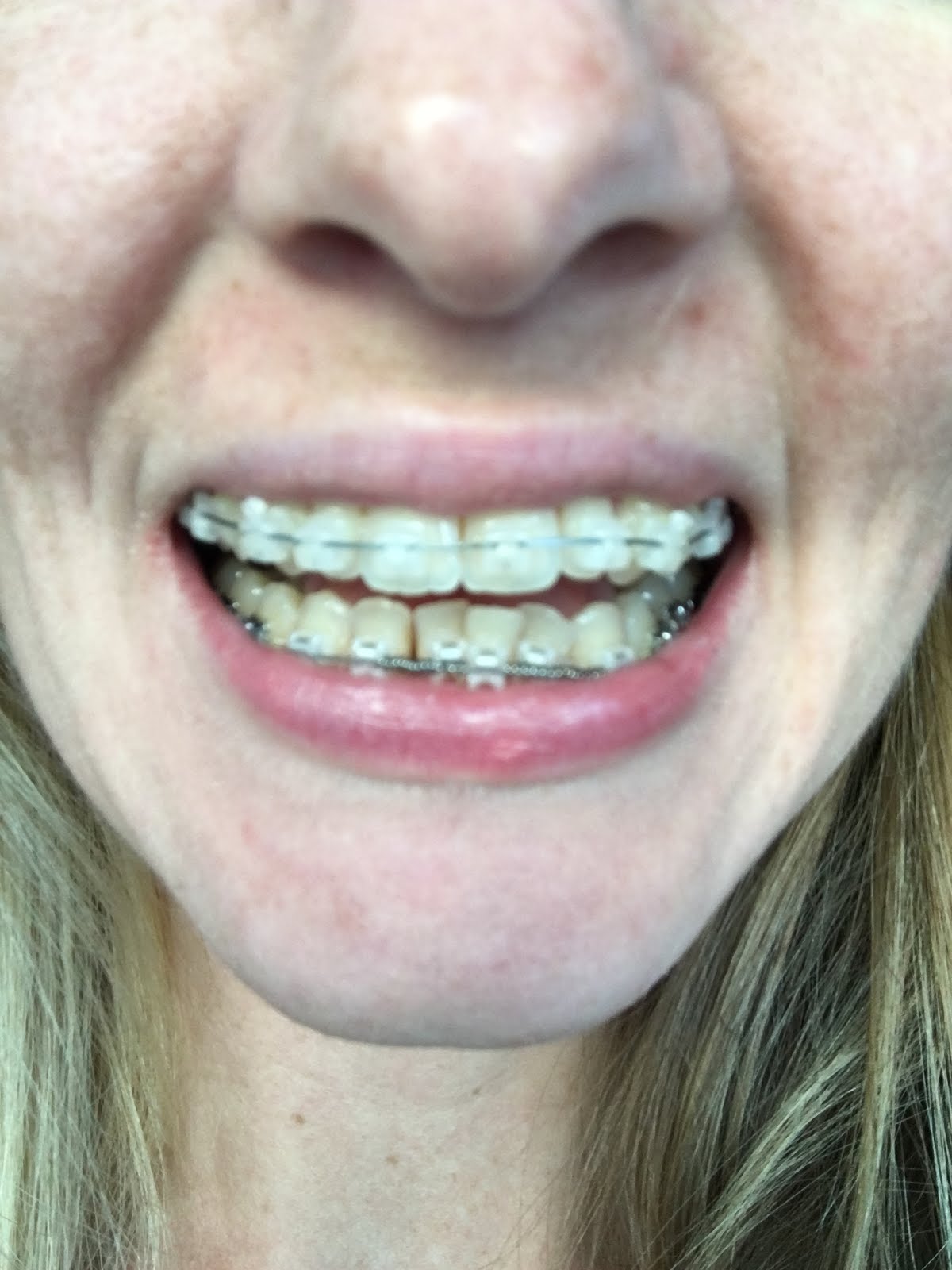Alison's Jaw Surgery Blog Braces Progress