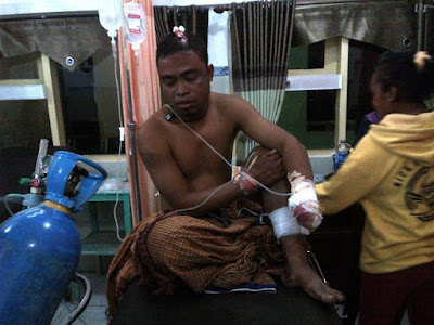 Ashar (30), Warga Sape yang putus tangan kiri akibat dibacok