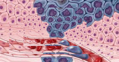 Cancer