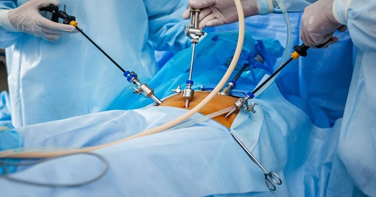 Dr.Malpani's Blog: Laparoscopy and IVF - before, after or never