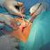 Monitorizacion  intraoperatoria del Nervio Laringeo Recurrente