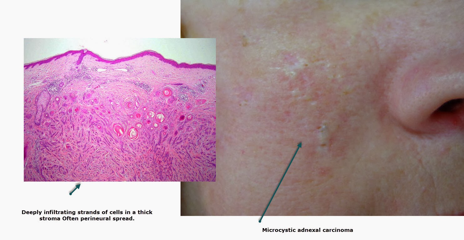 Malignant Sweat Gland Tumours - Dr Sampurna Roy MD ...