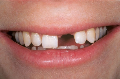 Gãy răng cửa có ảnh hưởng gì không?