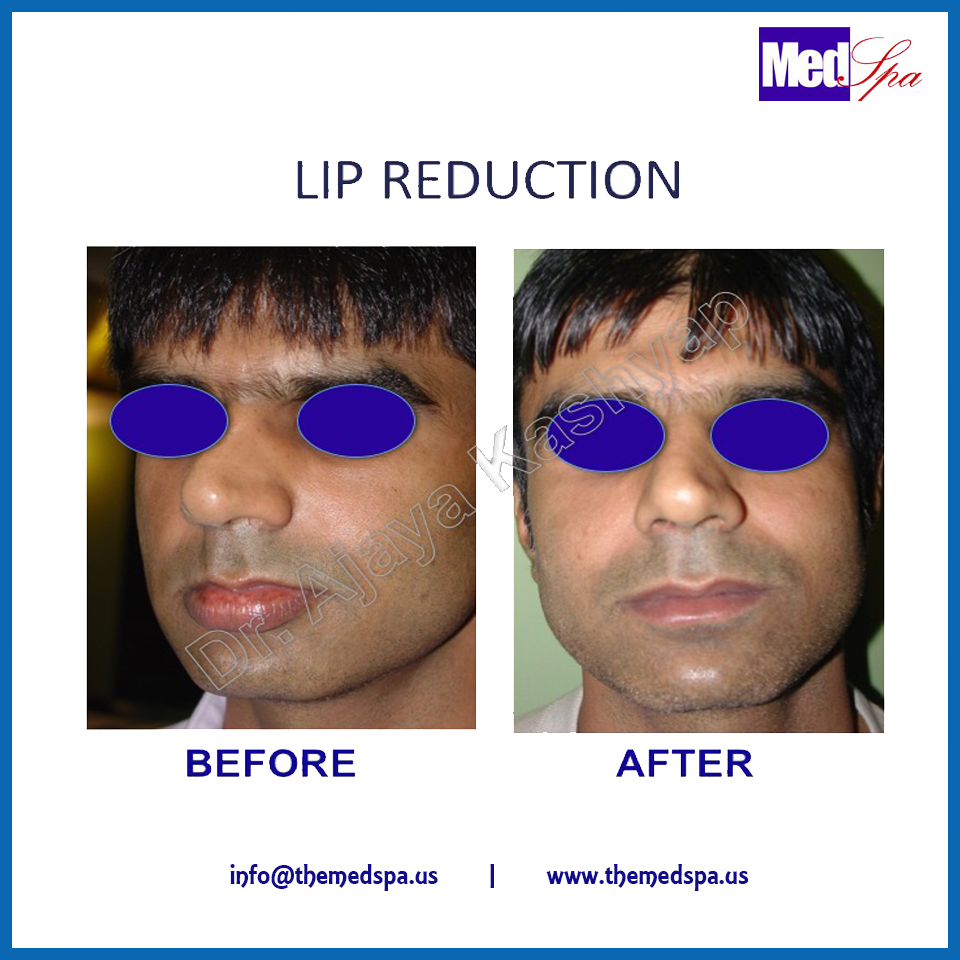 Lip reduction surgery procedure and cost
