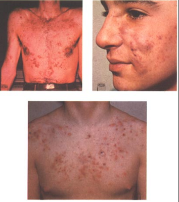 acné vulgaris