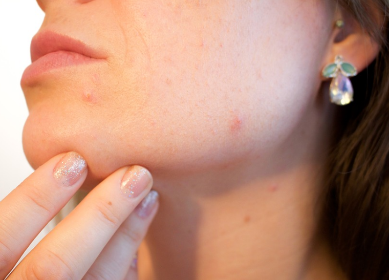 Proper Way of Overcoming The Stubborn Blackheads Proper Way of Overcoming The Stubborn Blackheads - healtinews
