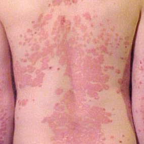  Eczema, Tolalarci, Skin alarci