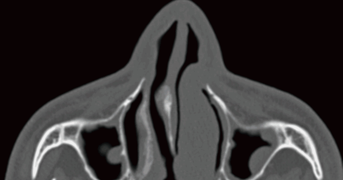 Deviasyon Ameliyatı İle İlgili Farklı Ayrıntılar