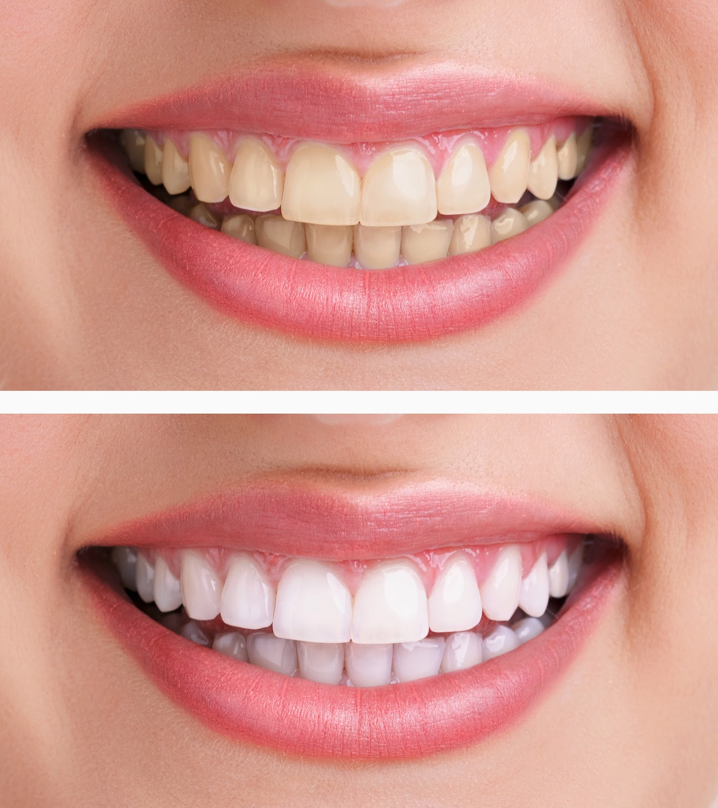 Wynnewood Dental Arts Whiter Teeth for a Brighter Smile