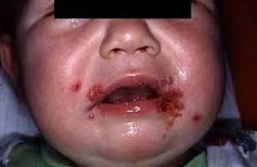 Obat Herpes pada Bibir Bayi
