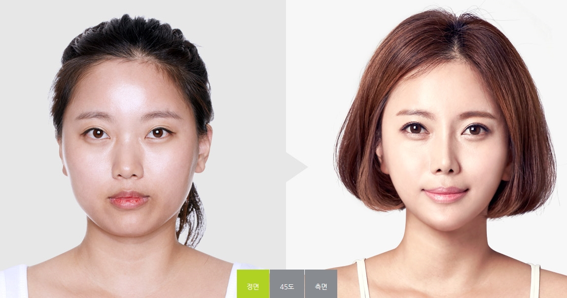 Before&After Before & After photos of Plastic surgery at TL.