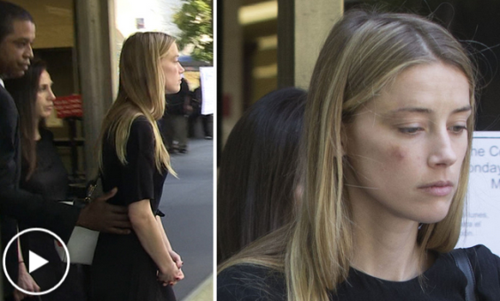 Amber Heard files for restraining order against Johnny Depp, claims physical assault (photos of her alleged injury)