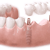 Lưu ý cần biết trong suốt quy trình trồng răng implant