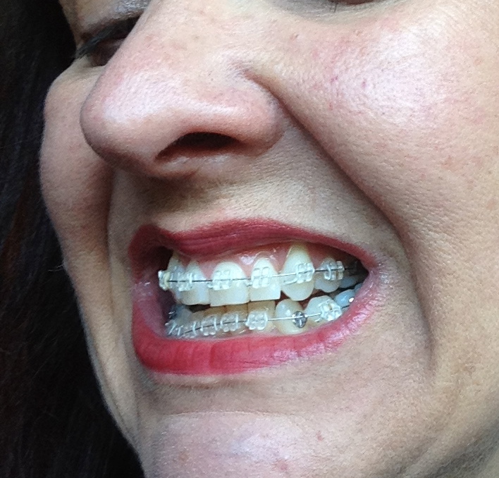 A Journey with my Teeth Broken Braces Wednesday 4th May 2016