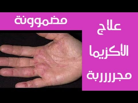 علاج الاكزيما جابر القحطاني