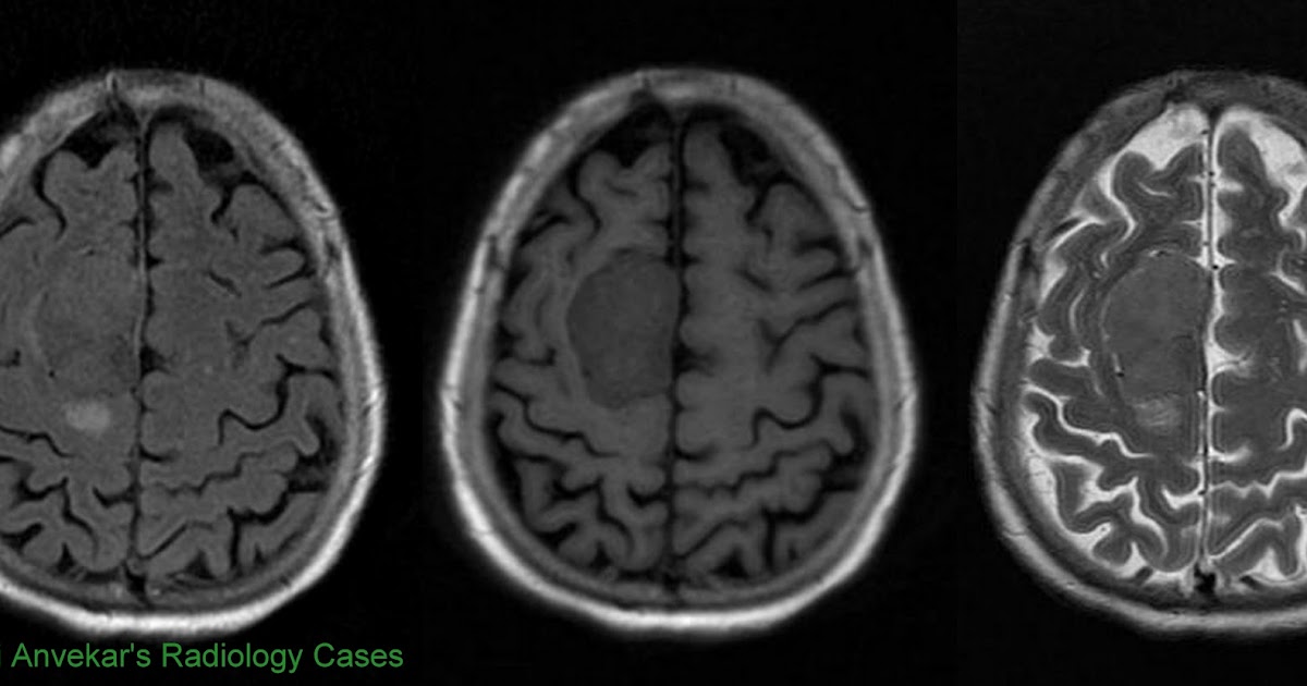 Фалькс мозга что это. Обызвествление falx cerebri что это. Менингиома фалькса. Falx cerebri кт. Серп головного мозга.