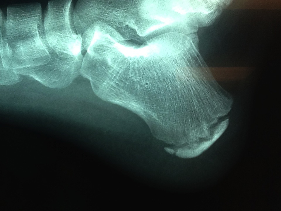 The Radiology Assistant : Special Ankle Fractures