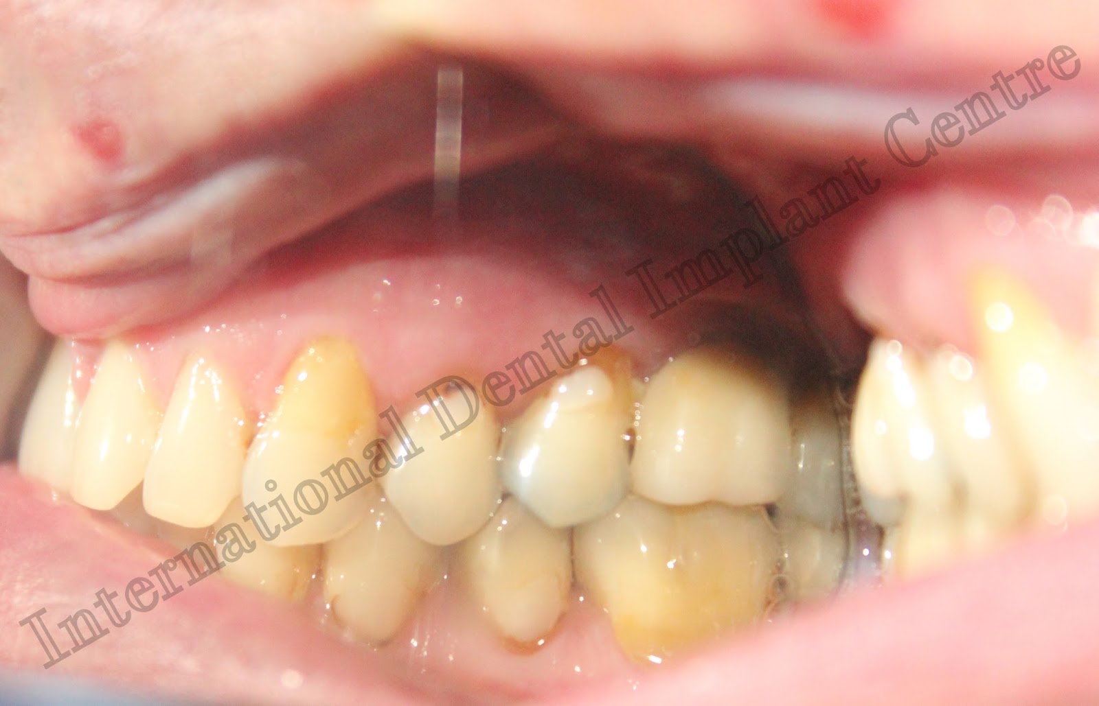 Dental implant cost guide india Replacement of molar teeth with basal