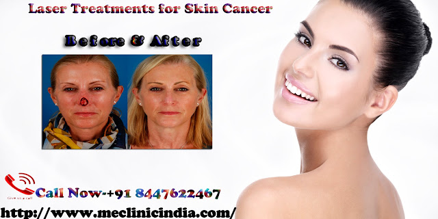 Laser Treatments for Skin Cancer