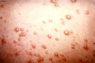 complicaciones de la varicela