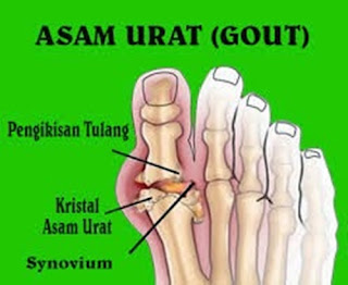 Asam Urat Menyerang Leher, Asam Urat Boleh Minum Air Kelapa, Asam Urat Dan Cara Menyembuhkan, Buah Pencegah Asam Urat Dan Kolesterol, Mengobati Asam Urat Rematik, Obat Herbal Asam Urat Dan Maag, Obat Kolesterol Asam Urat Gula Darah, Obat Asam Urat Yg Tersedia Di Apotik, Obat Tradisional Asam Urat Parah, Asam Urat Kolesterol Gula Darah Normal, Obat Herbal Utk Mengobati Asam Urat, Obat Alternatif Sakit Asam Urat, Asam Urat Terjadi Karena, Pencegahan Asam Urat Dan Rematik, Makanan Untuk Mengobati Asam Urat Dan Kolesterol, Harga Strip Gula Darah Kolesterol Asam Urat, Cara Alami Ngobati Asam Urat, Buah Obat Asam Urat Kolesterol, Kadar Asam Urat Dan Kolesterol Normal, Pantangan Orang Asam Urat Dan Kolesterol, Kapan Asam Urat Bisa Sembuh, Fungsi Asam Urat Dalam Tubuh Manusia, Penyakit Asam Urat Dan Obat Tradisionalnya, Cara Alami Hilangkan Asam Urat, Cara Menyembuhkan Asam Urat Pada Lutut, Cara Mengatasi Asam Urat Dengan Herbal, Pete Pantangan Asam Urat, Asam Urat Jamu Herbal, Asam Urat Super Tokopedia, Bolehkan Asam Urat Dipijat 