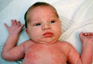 Obat Herbal Eksim Dermatitis Pada Bayi