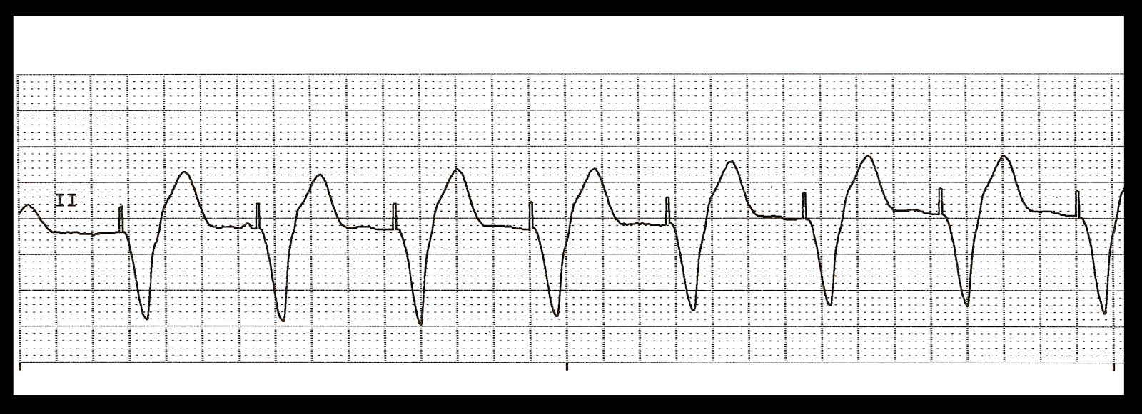 Basic EKG Rhythm Test 15